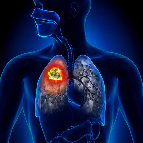 types de cancer du poumon
