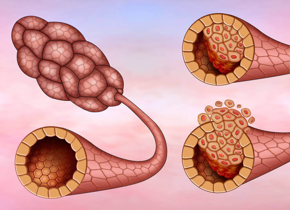 Types de cancer du sein