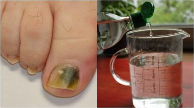 Recette à base d'alcool pour combattre les mycoses des ongles