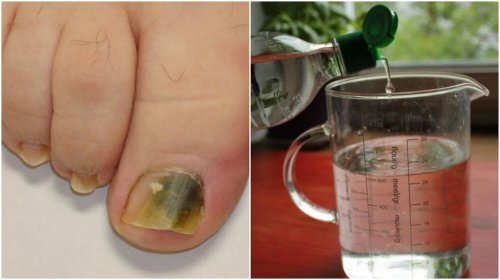 Recette à base d'alcool pour combattre les mycoses des ongles