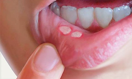 les solutions buccales et les aphtes