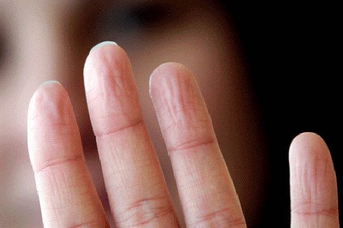 problèmes de santé signalés par l'aspect des mains : sueur excessive