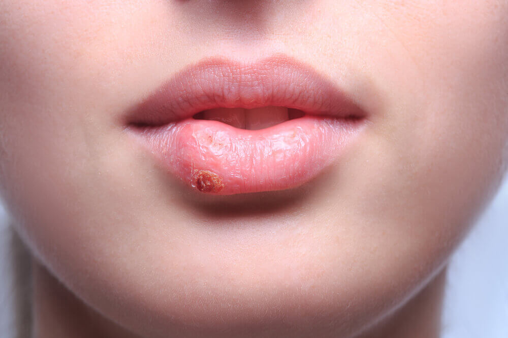 combattre l'herpès labial : comment il se propage