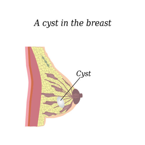 kystes des seins
