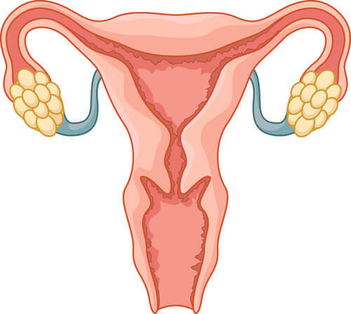 infertilité féminine : syndrome des ovaires polykystiques