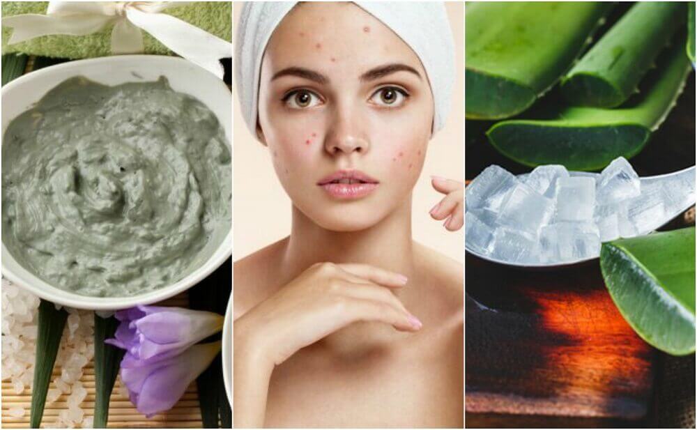 5 traitements d'origine naturelle contre les boutons