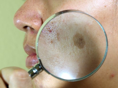 le mélasma sur le visage