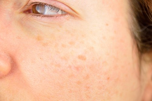 les taches sur le visage