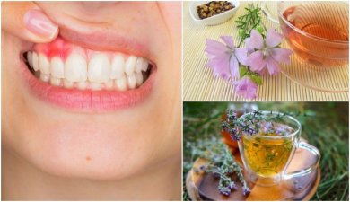 5 solutions naturelles pour contrôler les symptômes de la gingivite