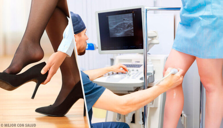 3 remèdes naturels pour soulager vos varices