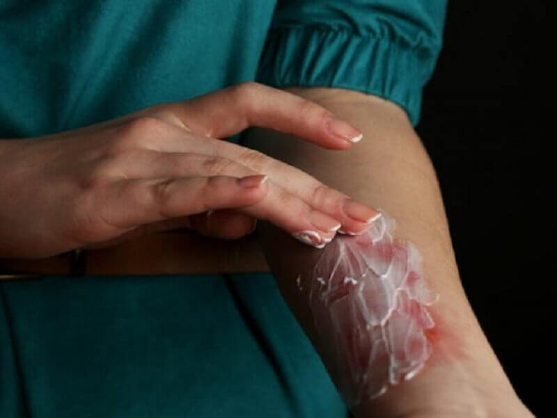 soulager les brûlures avec du yaourt naturel