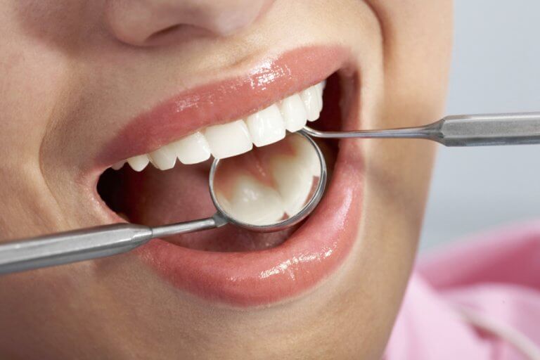 caries dentaires