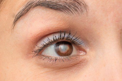 La cataracte touche de nombreuses personnes dans le monde.