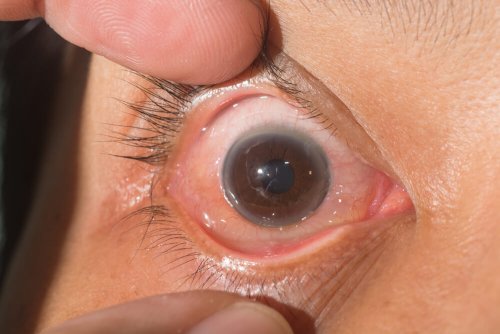 La cataracte sous-capsulaire est plus difficile à identifier.