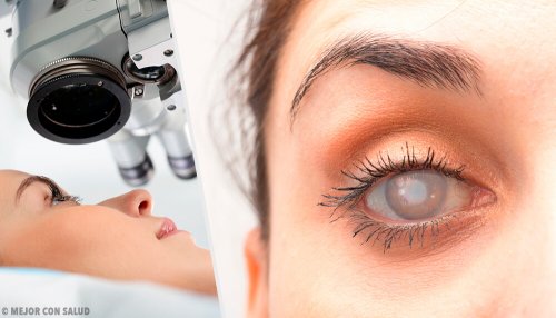 Cataracte : symptômes et traitements naturels