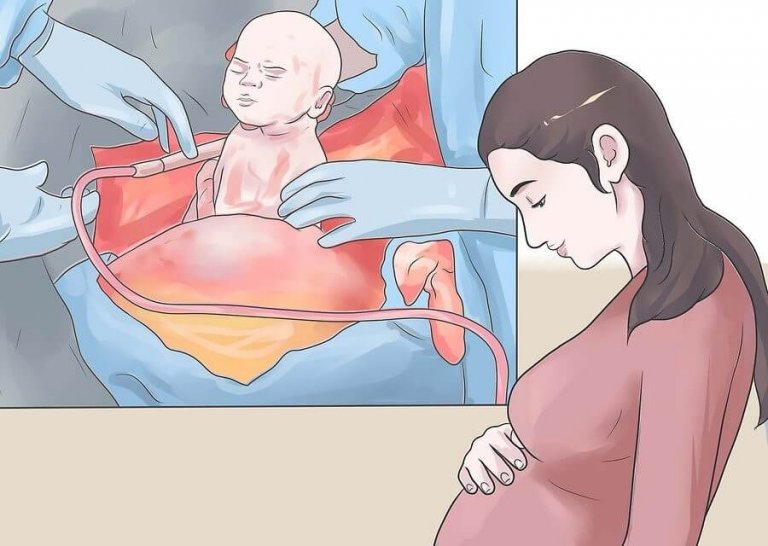 La peur de la césarienne au moment de l'accouchement