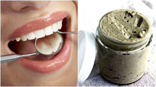 Comment traiter et prévenir les caries avec un remède 100% naturel
