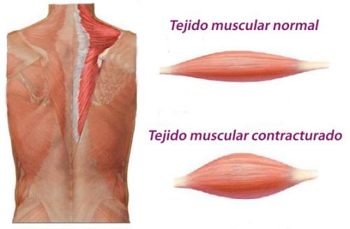 Contracture musculaire