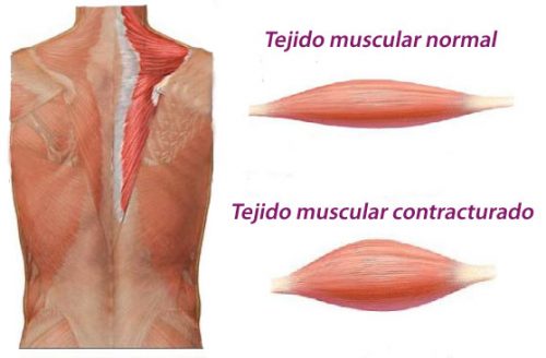 Contracture musculaire 
