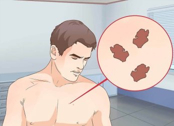 Quel est le traitement approprié pour un grain de beauté suspect ?