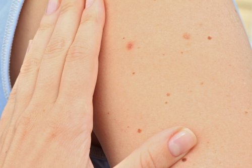 Grains de beauté suspect