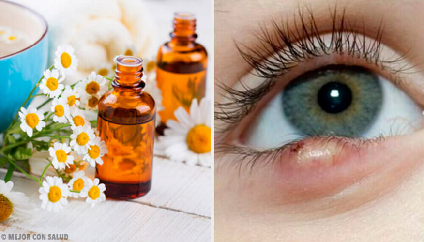 5 astuces pour éliminer facilement un orgelet