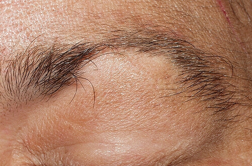 Queda de cabelo ligada a um ataque cardíaco.