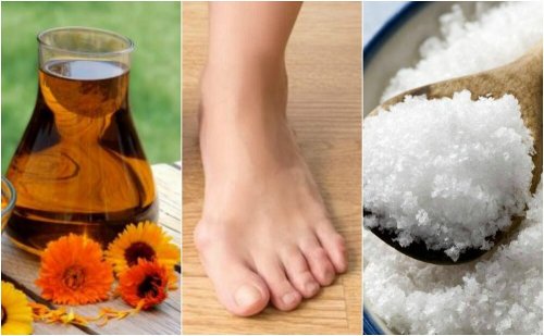 4 solutions naturelles pour réduire les oignons du pied