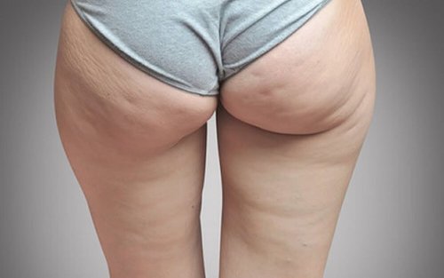 Lien entre rétention d'eau et cellulite