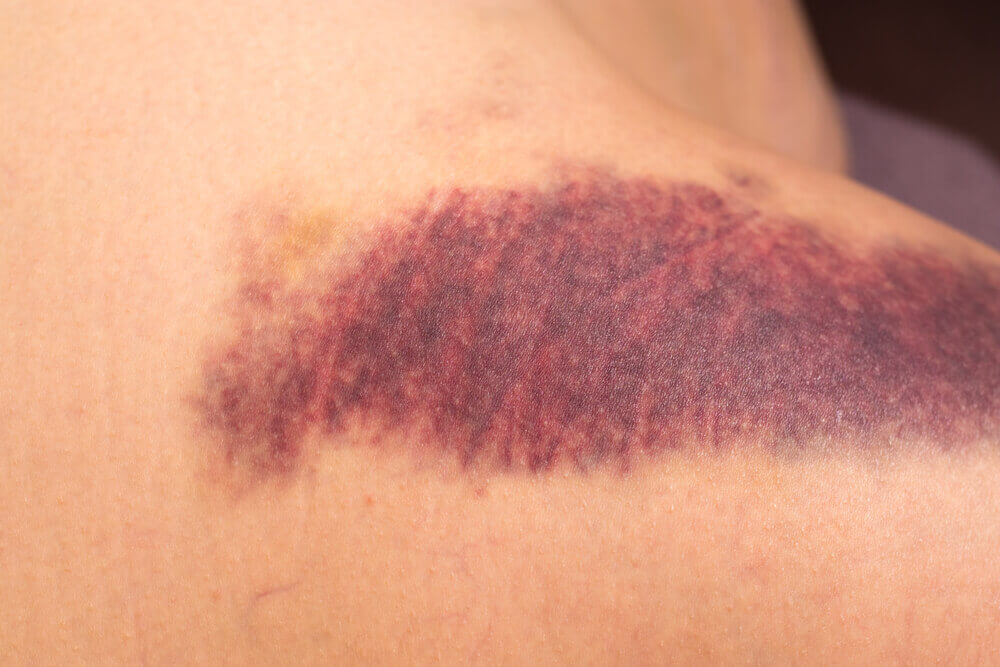 Le purpura est un des symptômes de carence en vitamine k.