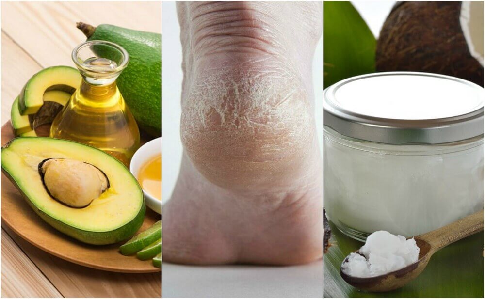 5 crèmes maison pour hydrater les talons secs 5 crèmes maison pour hydrater les talons secs