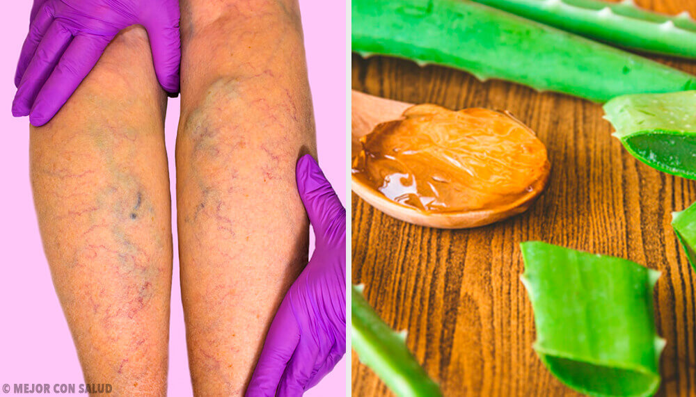 Traitez les varices avec ce remède à l’Aloe vera Traitez les varices avec ce remède à l’Aloe vera
