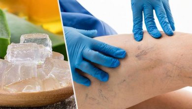 5 alternatives pour le traitement des varices