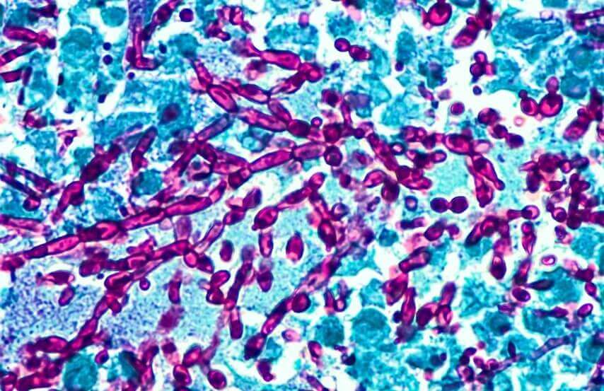 infections vaginales