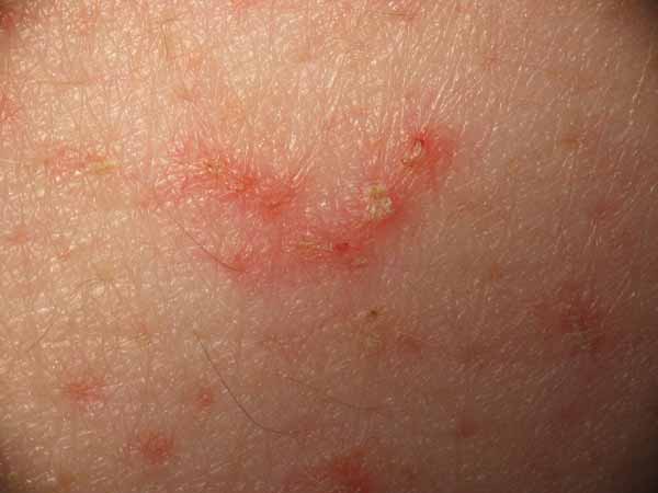 Utiliser l'aloe vera pour les allergies de la peau.