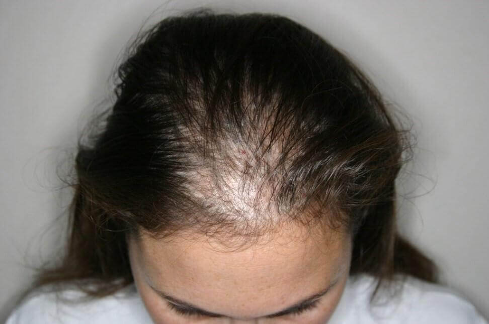 alopécie qui engendre une perte de cheveux