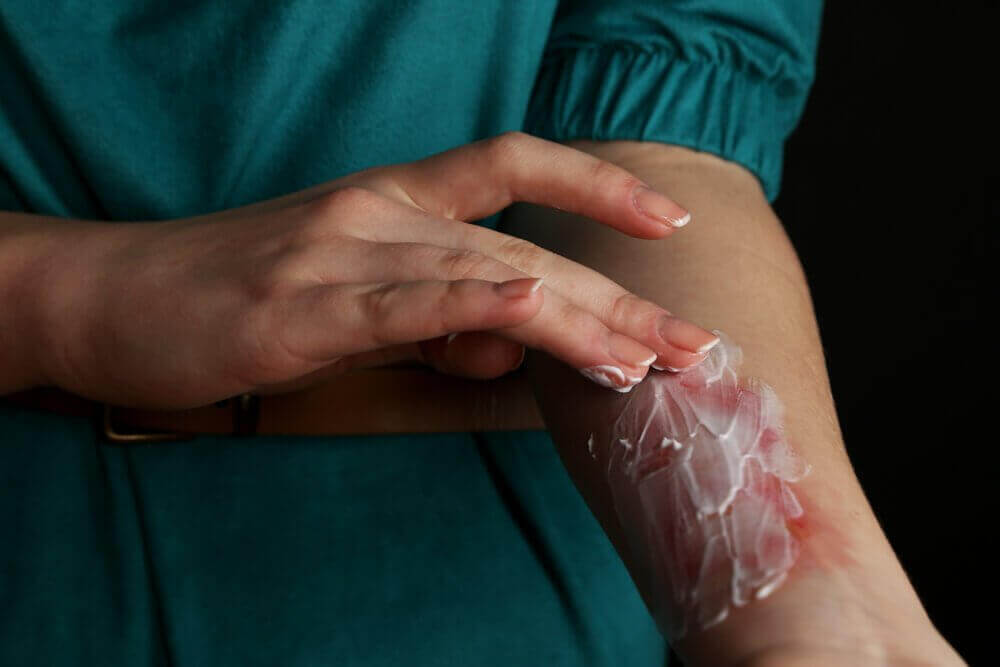 traitement contre les brûlures