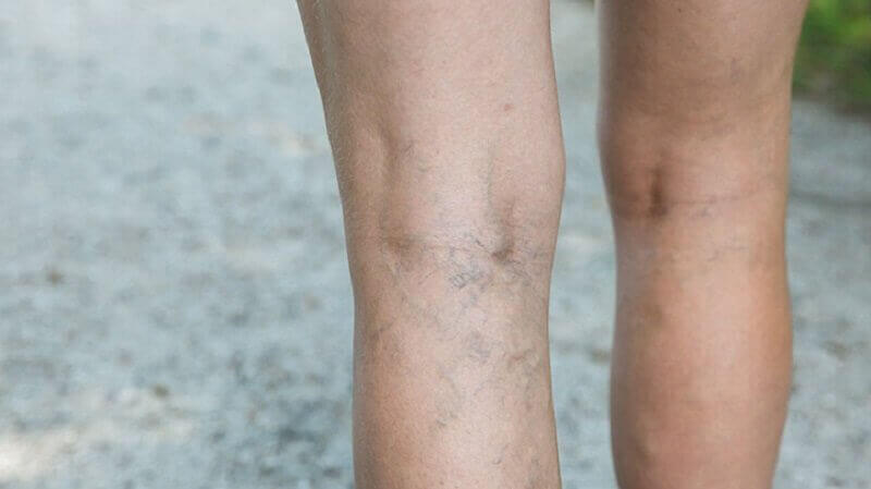 varices