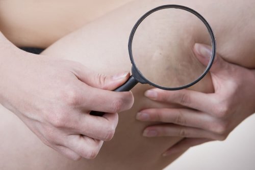 Cellulite aqueuse