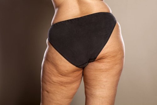 la cellulite