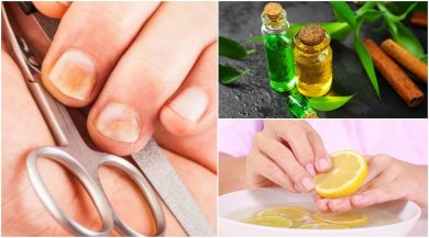 5 astuces maison faciles pour éliminer les champignons et renforcer les ongles