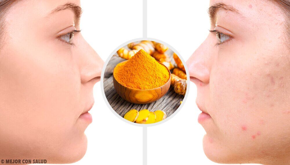 5 masques au curcuma pour éliminer les cicatrices d’acné 5 masques au curcuma pour éliminer les cicatrices d’acné