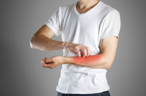 Les symptômes de l eczéma