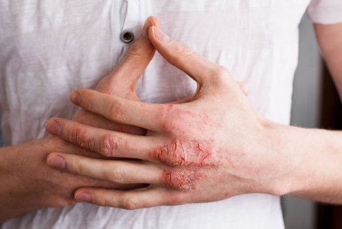 types d eczéma