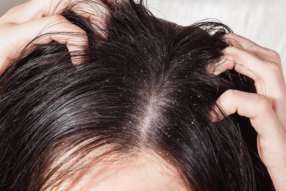 infection du cuir chevelu et pellicules