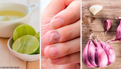 Remèdes maison contre les mycoses des ongles