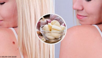 9 astuces pour éliminer les verrues au plus vite