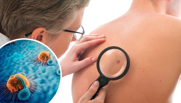 Quels sont les signes d'alerte du cancer de la peau et comment réagir ?