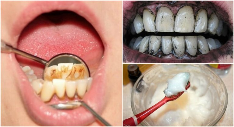 3 traitements efficaces pour éliminer le tartre de vos dents