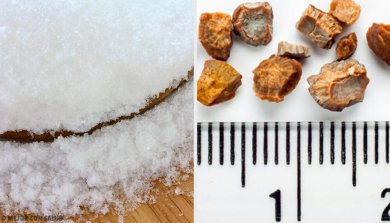 7 remèdes maison pour expulser les calculs rénaux